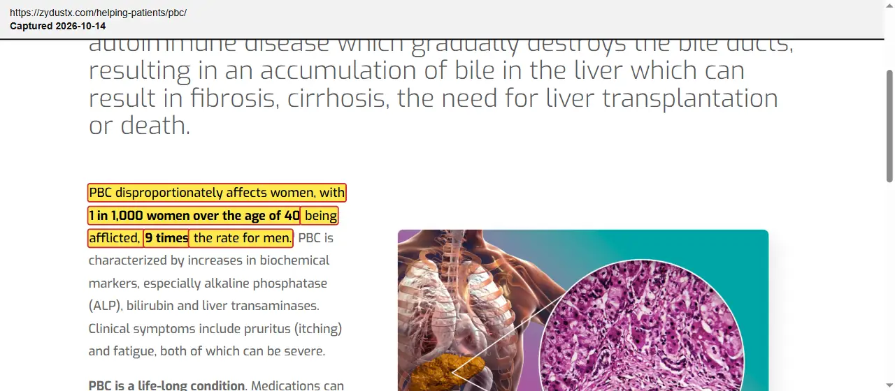 Zydus Therapeutics (2026) website, primary biliary cholangitis page, quoted passage highlighted